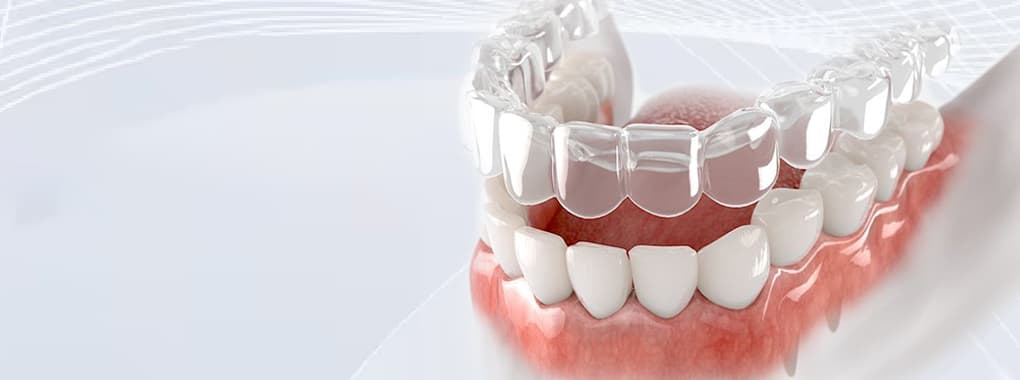 ISmile Aligners cover